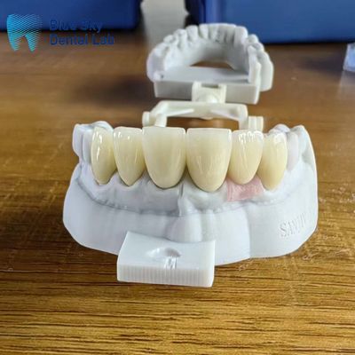 購入 高透明な層状ジルコニアの王冠 植入王冠 online manufacture