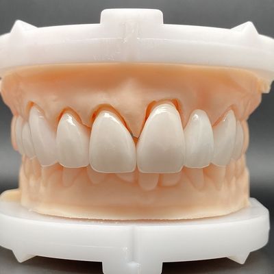 EMax フニエールケース 複数の色でパッシブフィッティング 歯の準備を最小限にして美しい笑顔を作ります